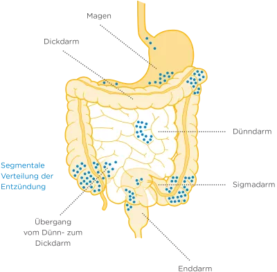 Morbus Crohn - Diagnose Bewegung