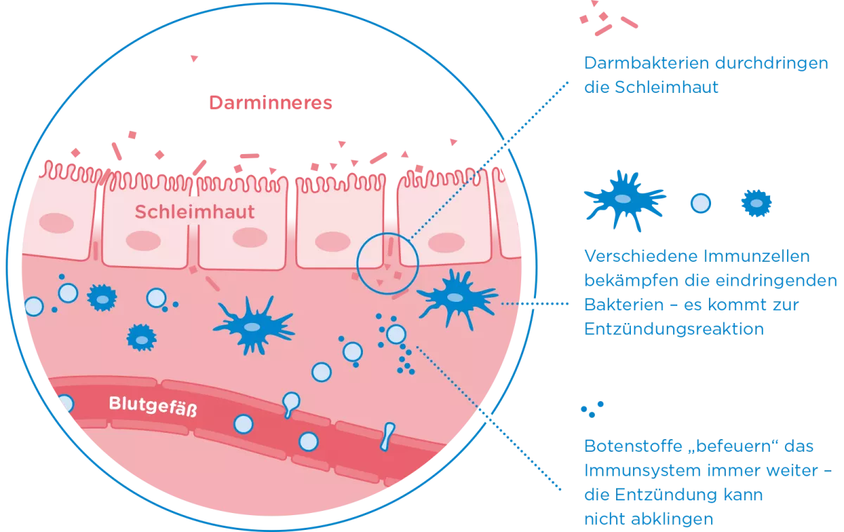 Colitis ulcerosa - Darminneres